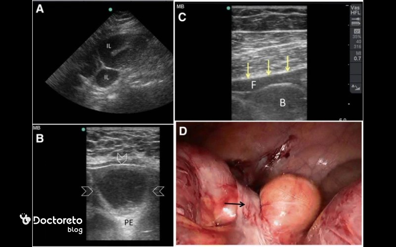 سونوگرافی برای تشخیص سرطان روده حین عمل نیز می تواند انجام دهد.