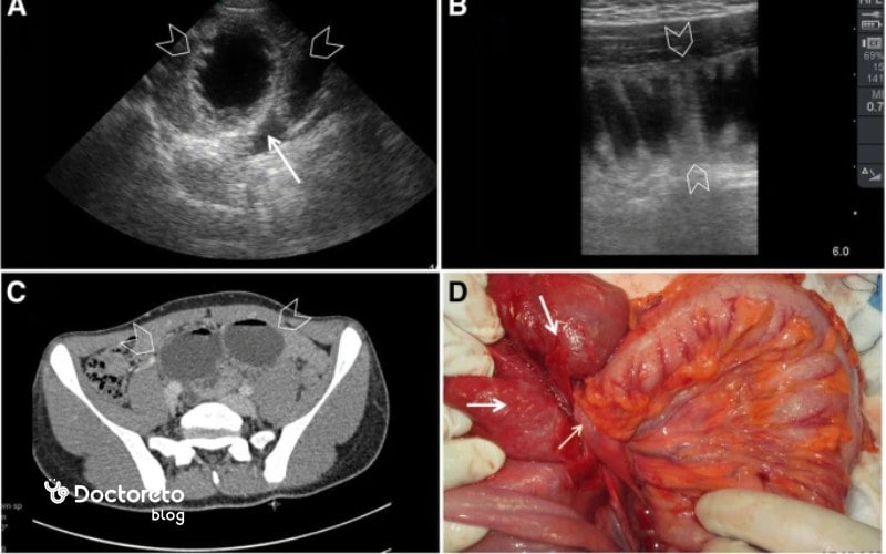 انواع سونوگرافی برای تشخیص سرطان روده انجام می شود.