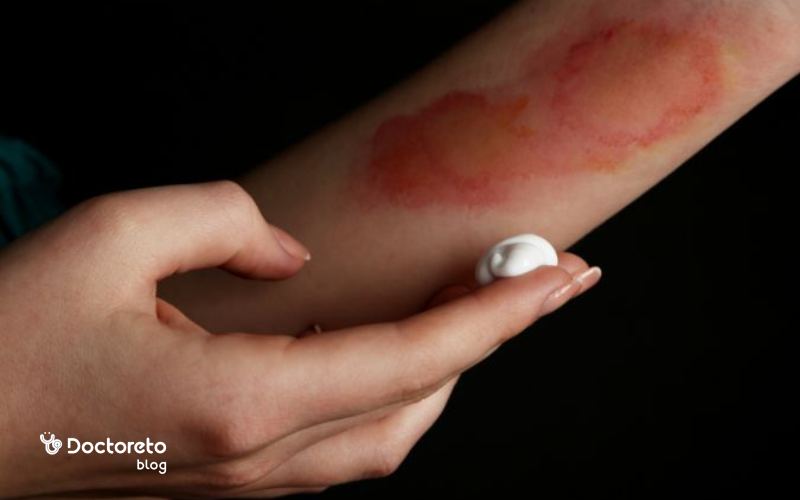 بهترین پماد برای سوختگی با آب جوش چیست؟