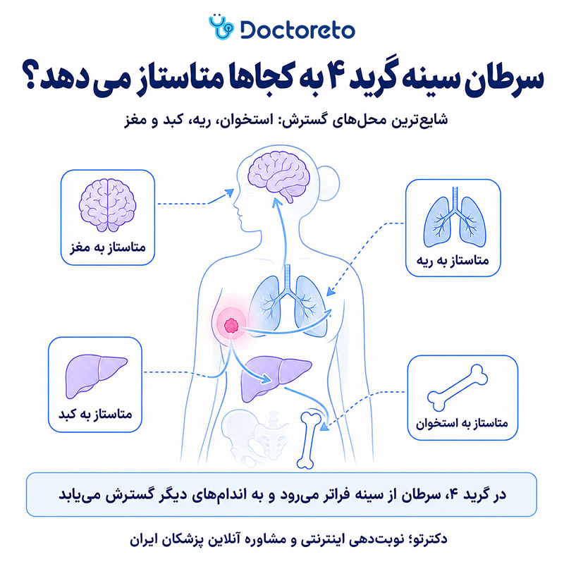 اینفوگرافیک سرطان سینه گرید 4