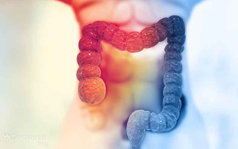 شانس زنده ماندن در سرطان روده چقدر است؟