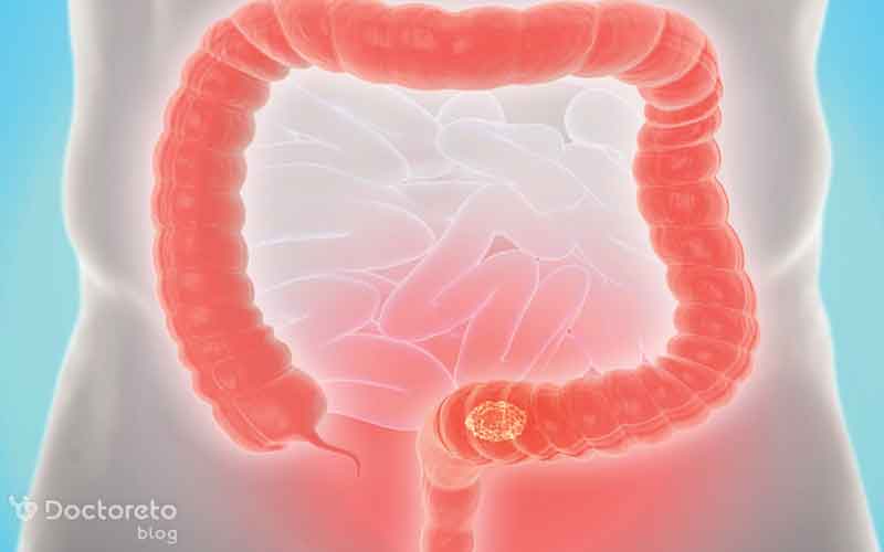 زمان تشخیص بیماری در تعیین سرطان روده موثر است.