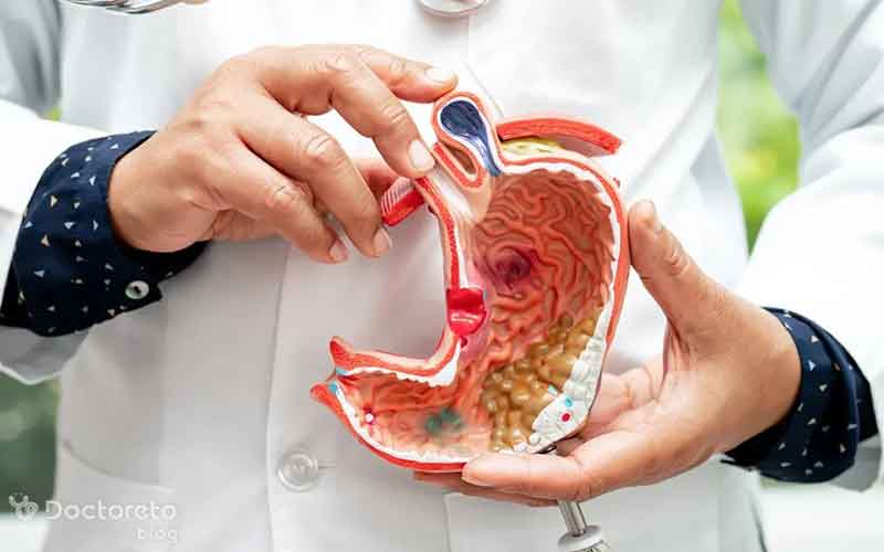 درمان قطعی سرطان معده بدخیم در مراحل اولیه