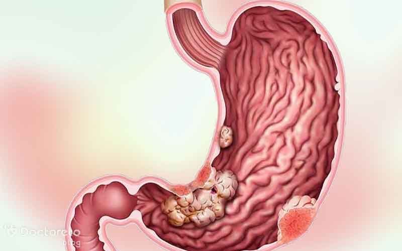 تشخیص سرطان معده با اندوسکوپی چگونه است؟