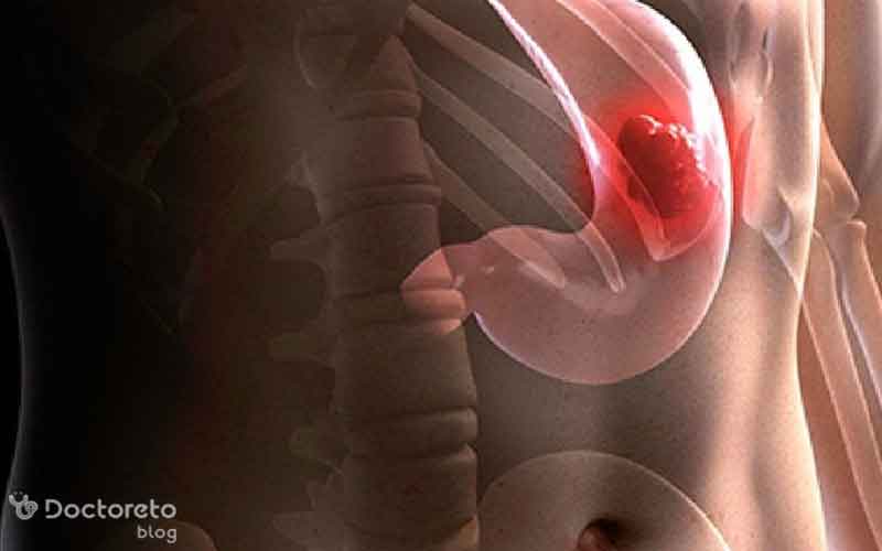 تشخیص سرطان معده با اندوسکوپی چگونه است؟