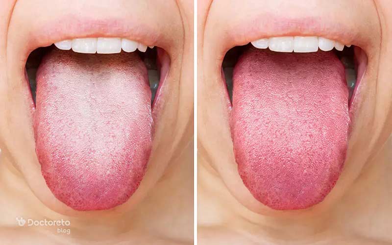 تغییر رنگ و ظاهر از علائم کبد چرب روی زبان است. 