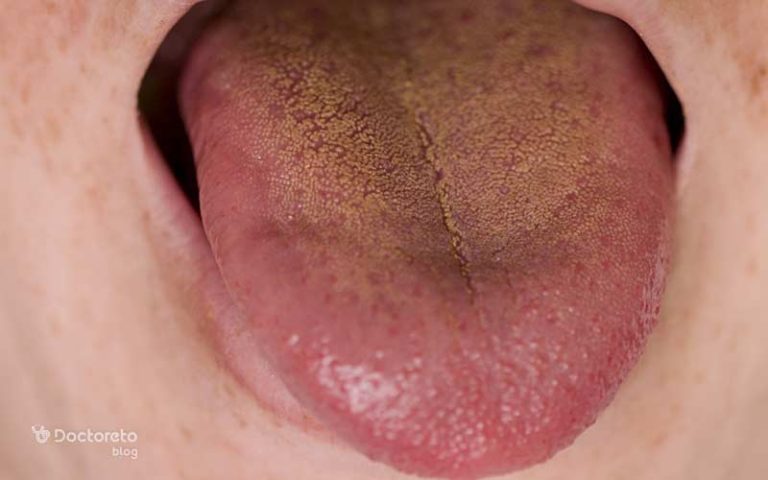 علائم کبد چرب در زبان چیست؟