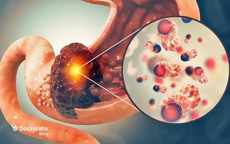 عاقبت سرطان معده بعد از تشخیص در مراحل اولیه چگونه است؟
