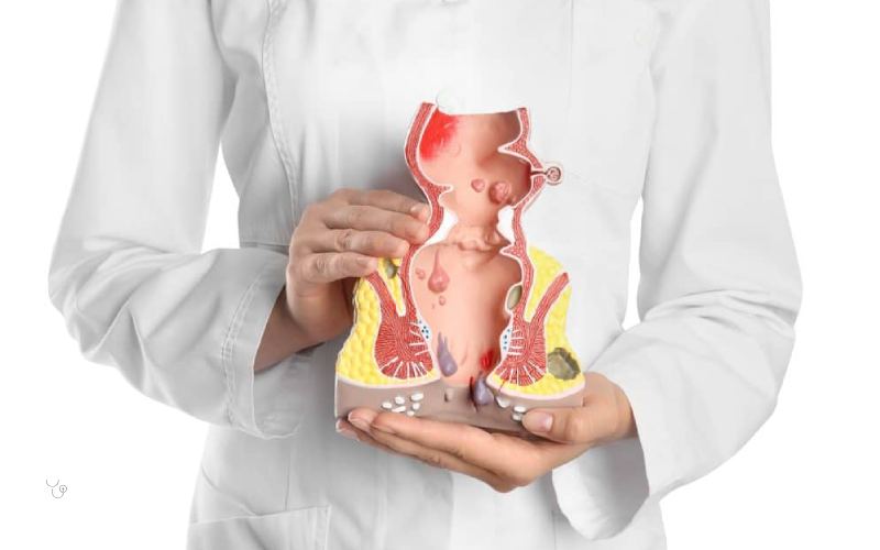 تفاوت علائم هموروئید و سرطان روده چیست؟