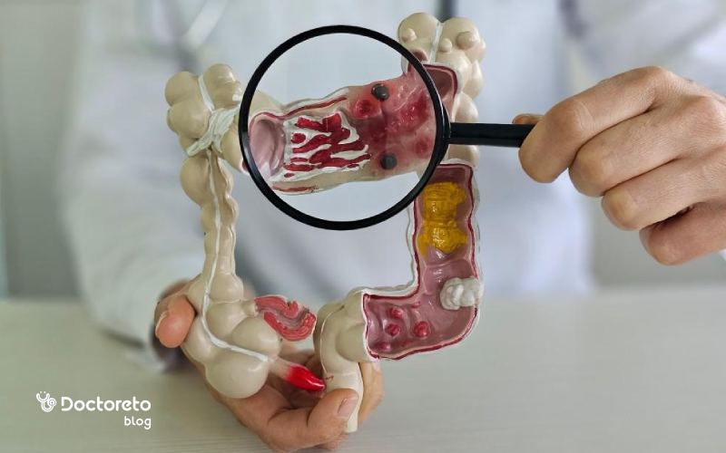 آیا سرطان روده بزرگ بدخیم درمان دارد؟