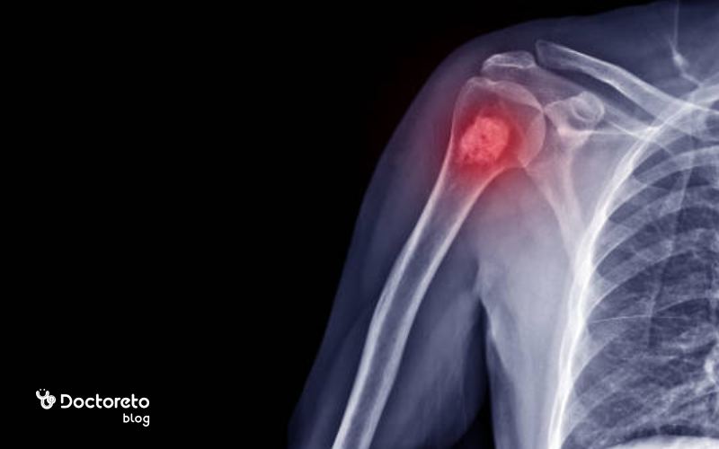 ایا سرطان مغز استخوان کشنده است؟ واقعیت‌ های مهم که باید بدانید