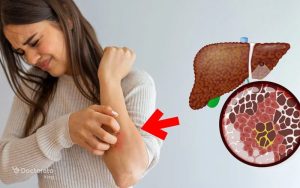 آیا خارش از علائم کبد چرب است؟