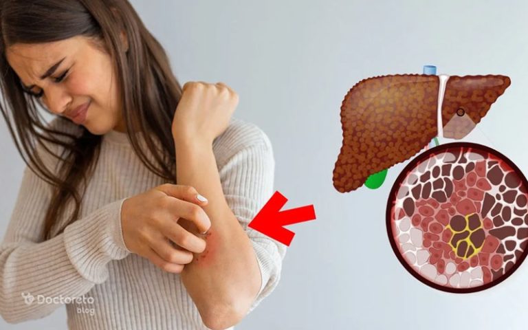 آیا خارش از علائم کبد چرب است؟