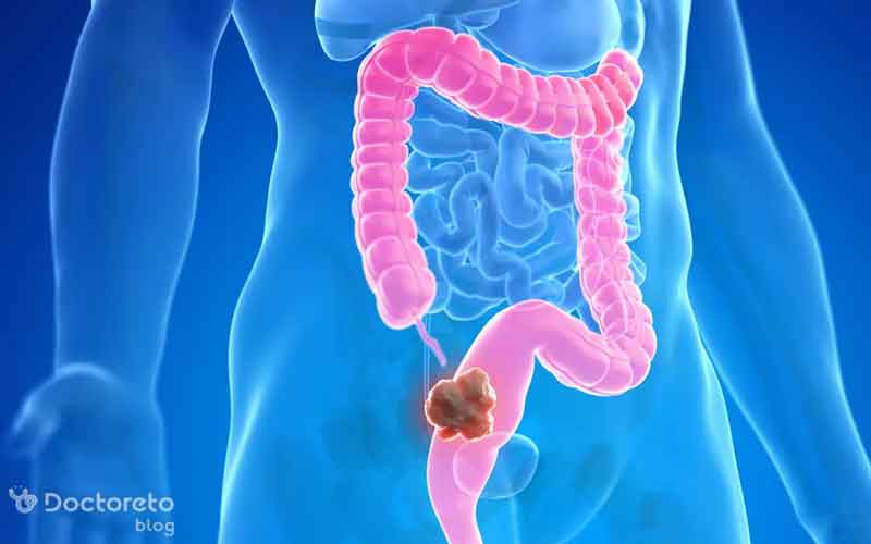 زمان مرگ سرطان روده چه وقتی است؟