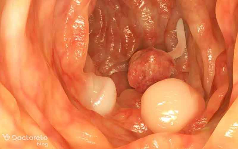 طول عمر بیماران سرطان روده در مراحل مختلف چقدر است؟
