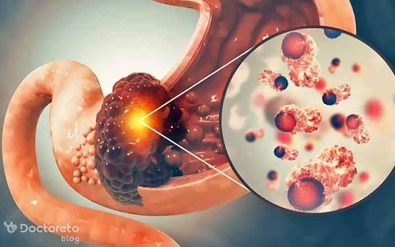 نشانه‌ ها و علائم سرطان معده بدخیم را بشناسید