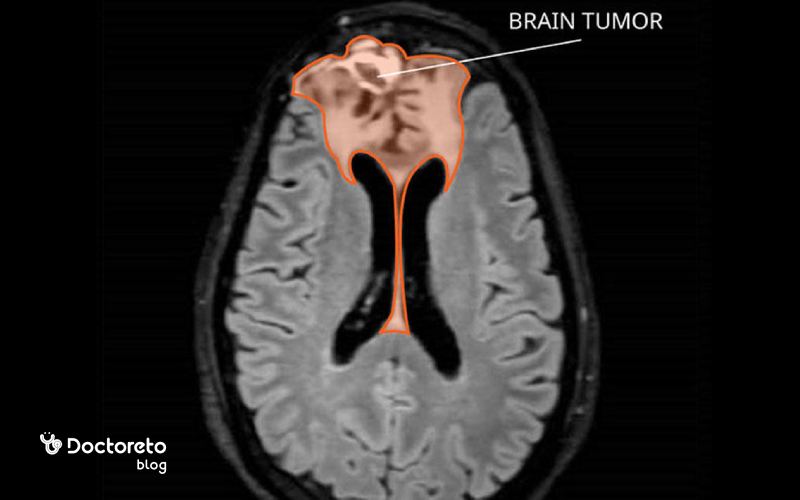 عکس MRI تومور مغزی بدخیم چگونه است؟