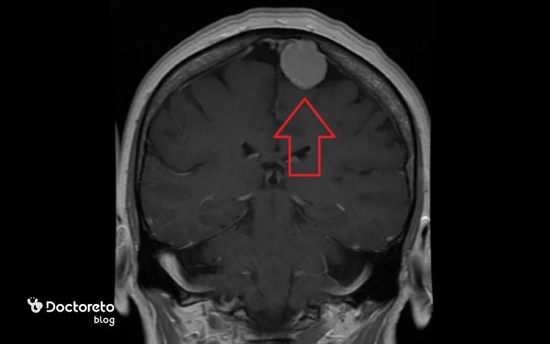 عکس تومور مغزی بدخیم در مراحل اولیه چگونه است؟