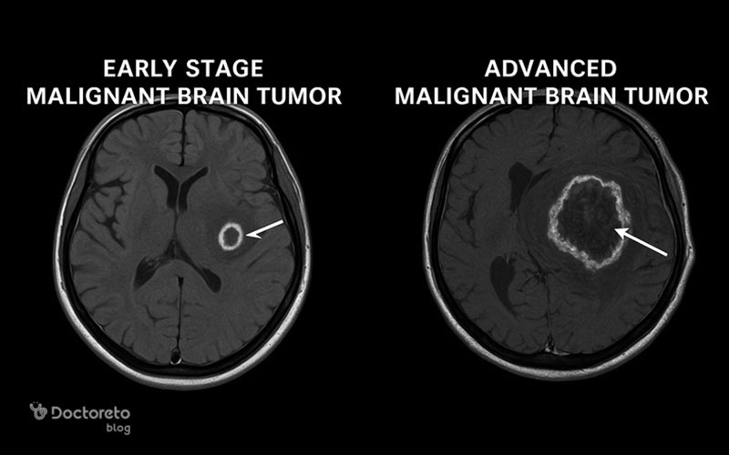 عکس تومور مغزی بدخیم