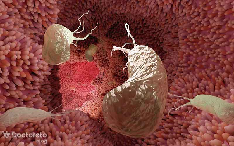 عکس سرطان معده خوش خیم