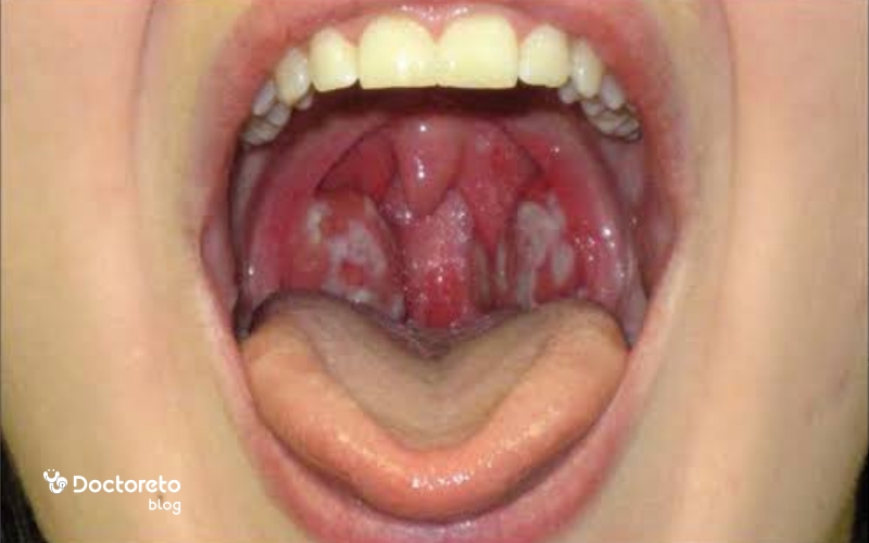فارنژیت یا التهاب گلو چگونه تشخیص داده می شود؟