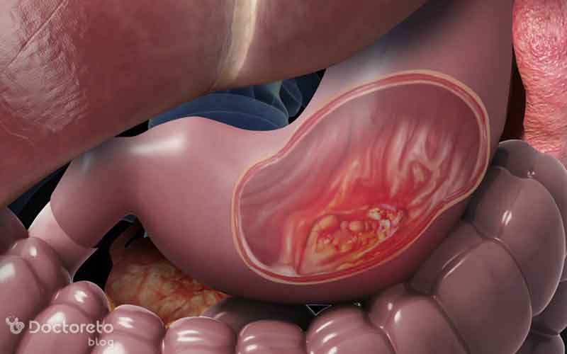درمان سرطان معده بدخیم چیست؟