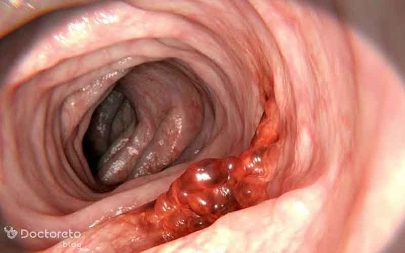 آیا زخم روده سرطان است؟