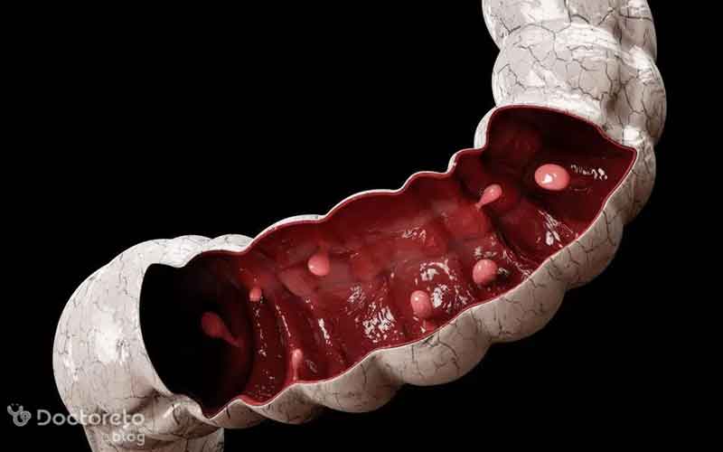 آیا زخم روده سرطان است؟