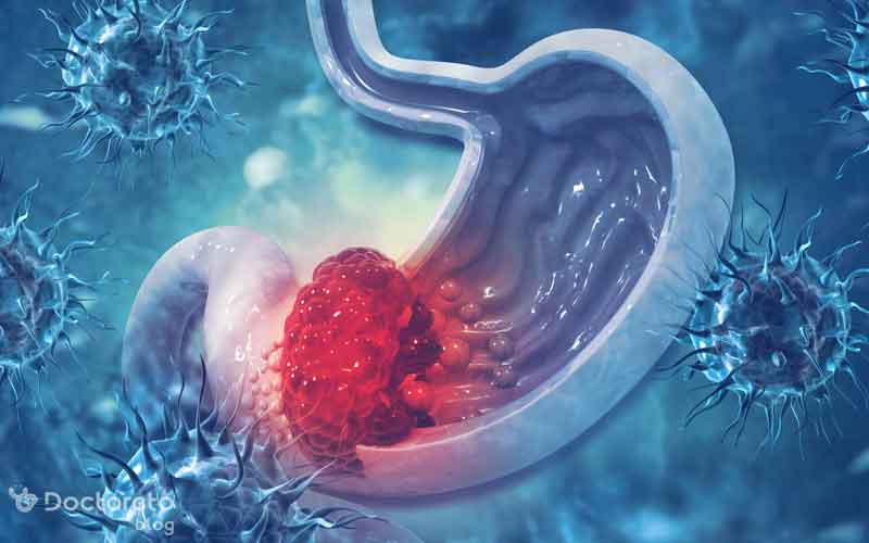 فواید داروهای سرطان معده خوش خیم چیست؟
