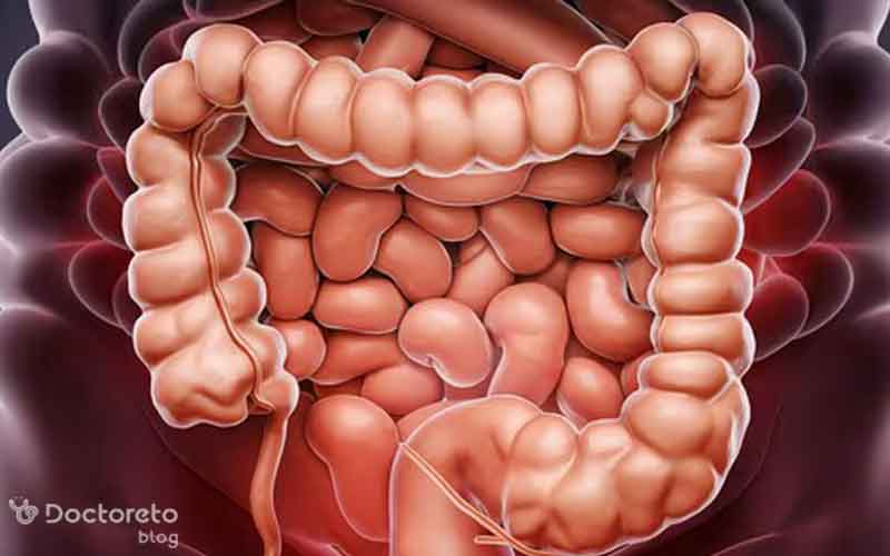 آیا سندرم روده تحریک پذیر باعث سرطان می شود؟