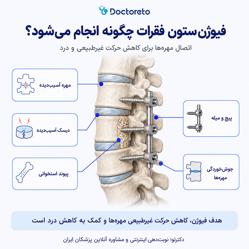 اینفوگرافی فیوژن ستون فقرات