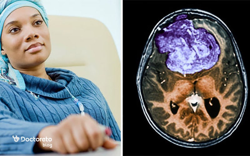 انواع سرطان مغز چیست؟ کدام خوش خیم و کدام بدخیم است؟