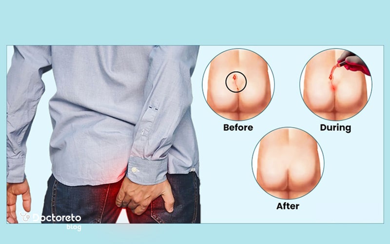 مراحل انجام عمل فیستول با لیزر شامل چه مواردی است؟