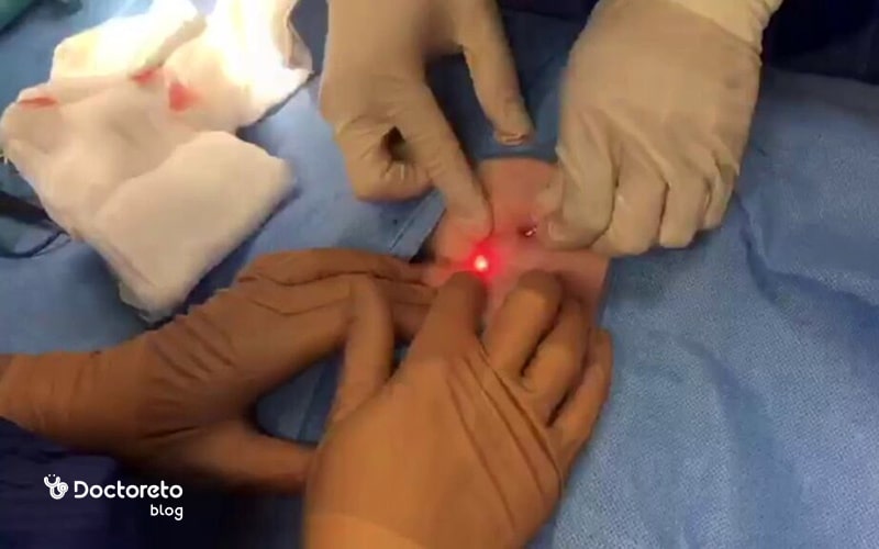 مزایای عمل فیستول با لیزر چیست؟