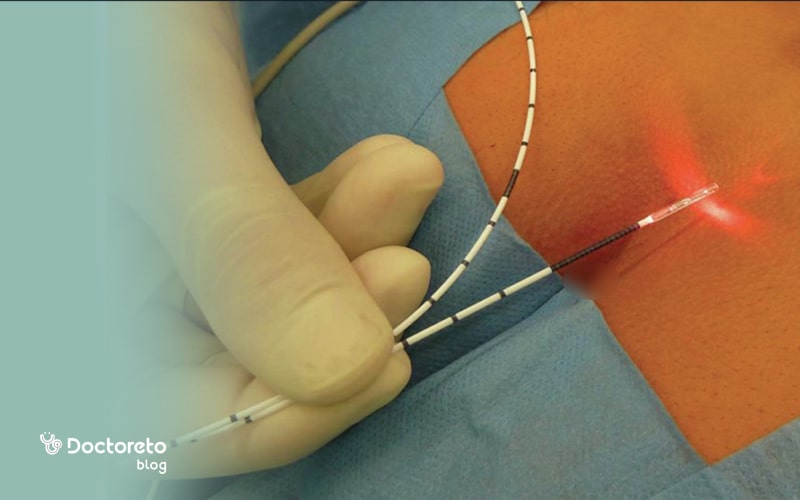 عمل فیستول با لیزر چه عوارضی دارد؟