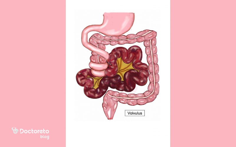 اقدامات فوری و اورژانسی برای پیچ خوردگی روده چیست؟