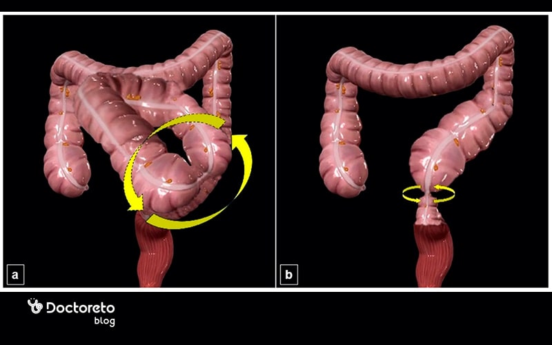 علائم اولیه پیچ خوردگی روده چیست؟