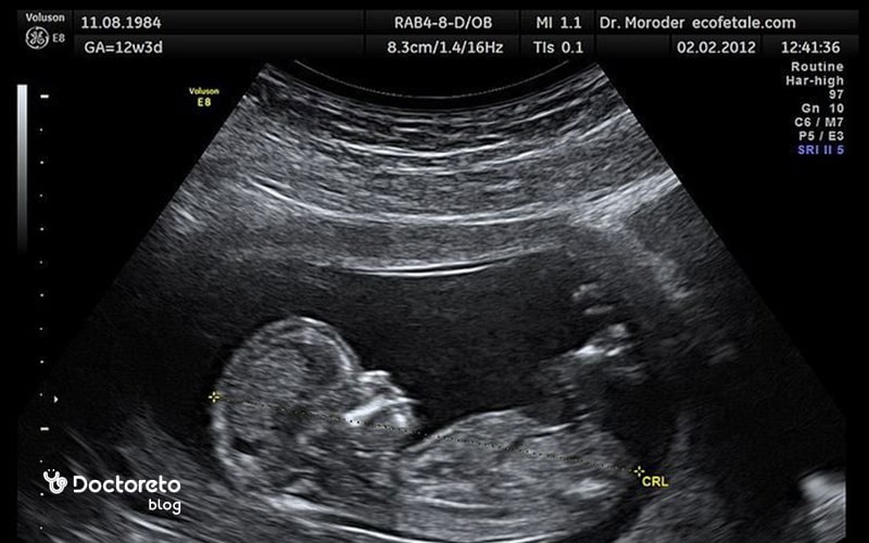 اکوژن در سونوگرافی بارداری یعنی چه؟