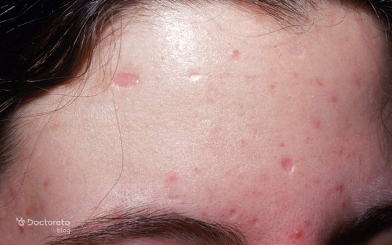 در چه صورت جای آبله مرغان می ماند؟