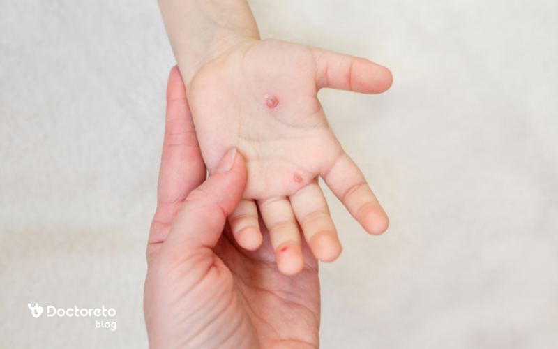 مدت زمان ماندگاری جوش‌های آبله مرغان چقدر است؟