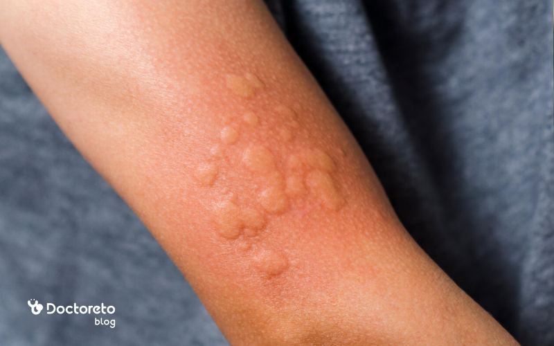 مرحله دوم جوش آبله مرغان چه علائمی دارد؟