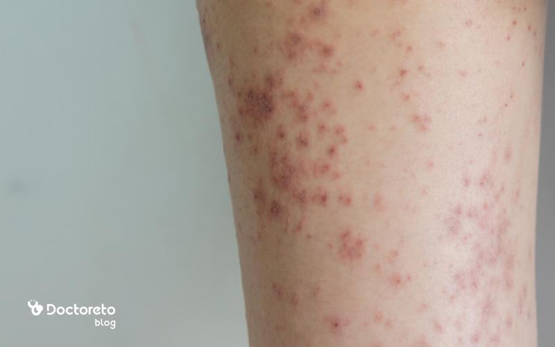 مرحله چهارم جوش آبله مرغان چیست؟