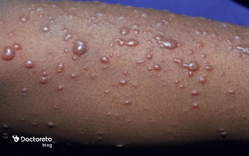 مرحله سوم جوش آبله مرغان چیست؟