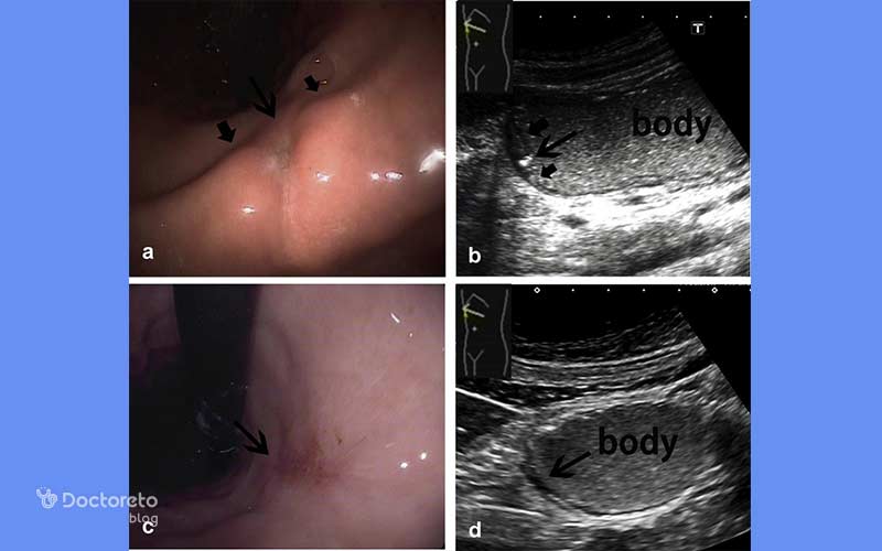 عکس زخم سرطان معده خوش خیم بدین شکل است.