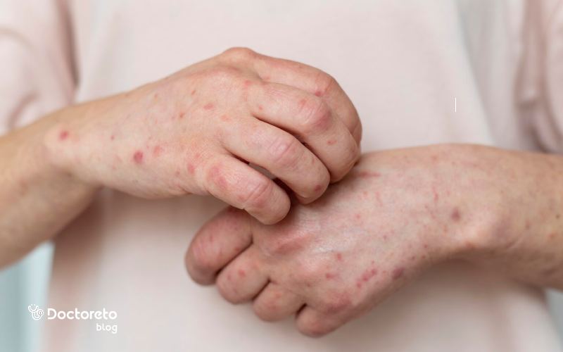 تفاوت آبله مرغان با حساسیت چیست؟