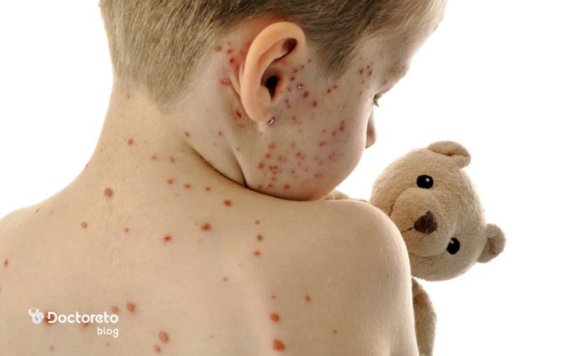 آبله مرغان چگونه منتقل می‌شود؟