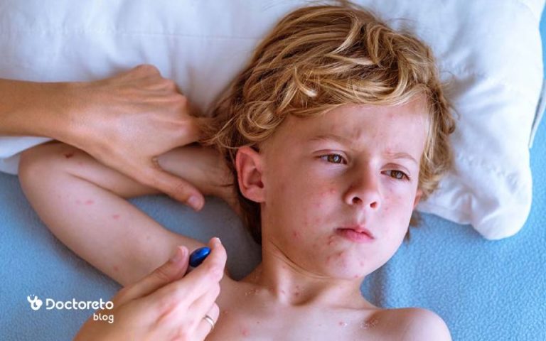 کدام قرص ضد خارش ابله مرغان تاثیر بیشتری دارد؟