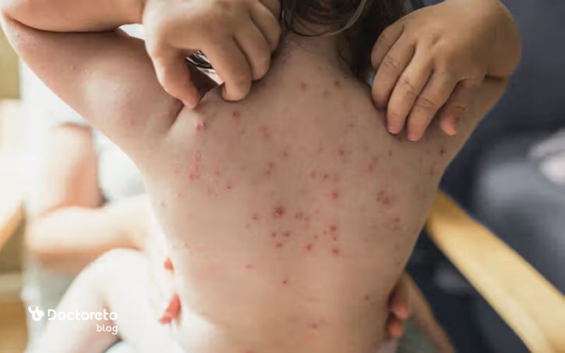 آیا مصرف قرص ضد خارش آبله مرغان برای کودکان ایمن است؟