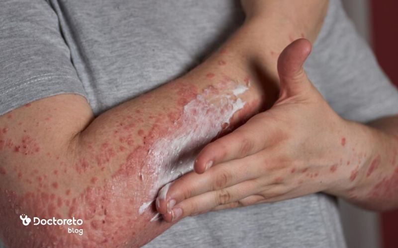 آیا آبله مرغان بزرگسالان بدون دارو بهبود می یابد؟