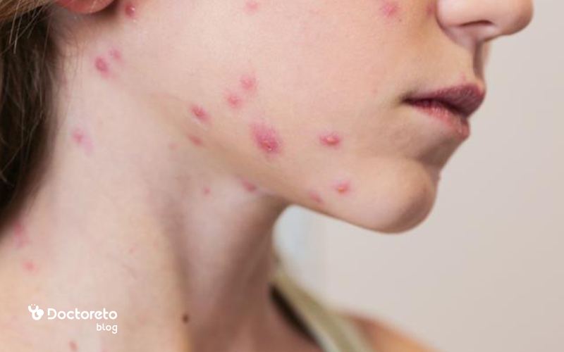 آیا داروهای ضدویروس باید در همان روزهای اول بیماری مصرف شوند؟